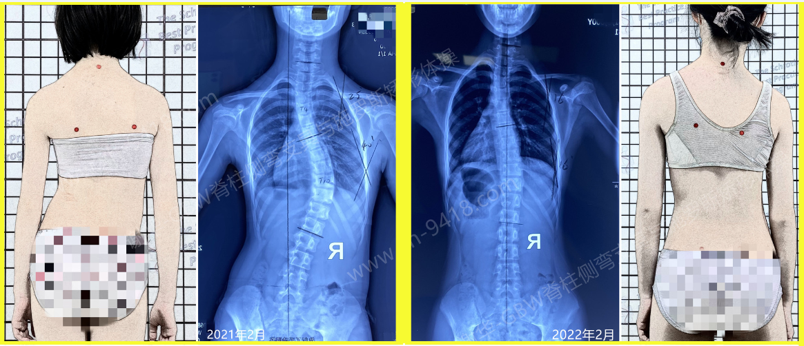 GBW支具矫正案例20220212——40度到16度1年的努力 GBW脊柱侧弯支具矫正案例 第2张