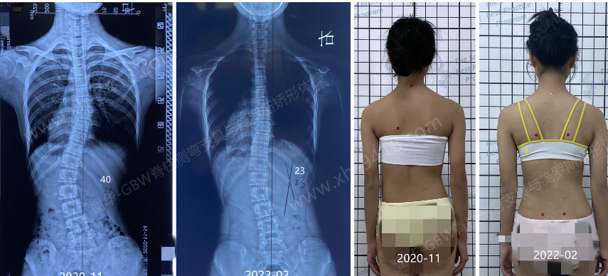 GBW支具持续矫正案例-有生长激素治疗史20220315 GBW脊柱侧弯支具矫正案例 第1张