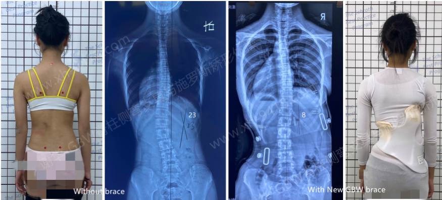 GBW支具持续矫正案例-有生长激素治疗史20220315 GBW脊柱侧弯支具矫正案例 第2张