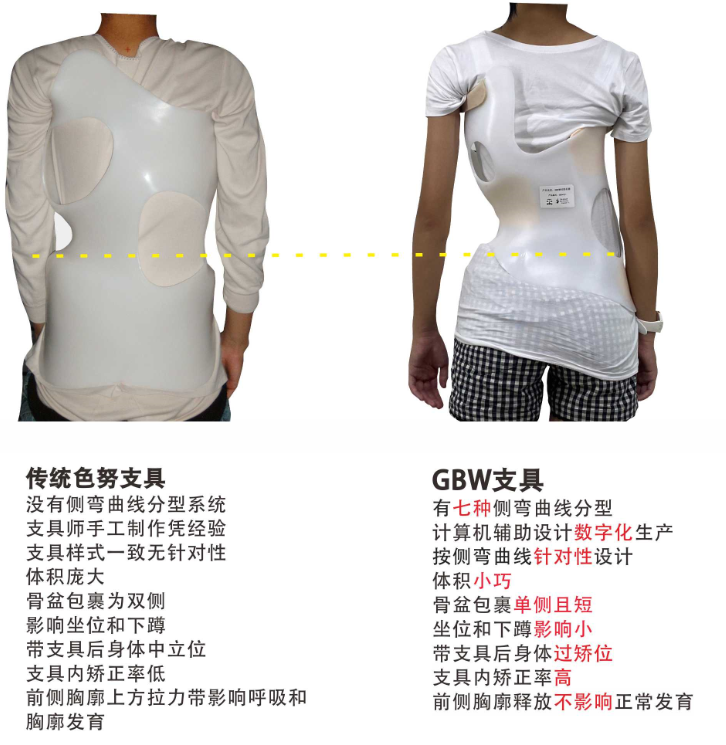 GBW支具与传统支具对比案例 GBW脊柱侧弯支具矫正案例 第3张