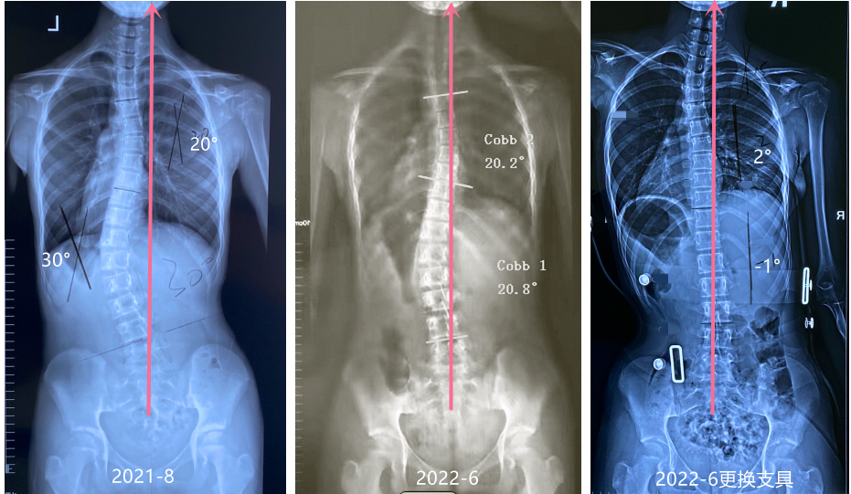 GBW支具矫正案例20220625    GBW脊柱侧弯支具矫正案例 第2张