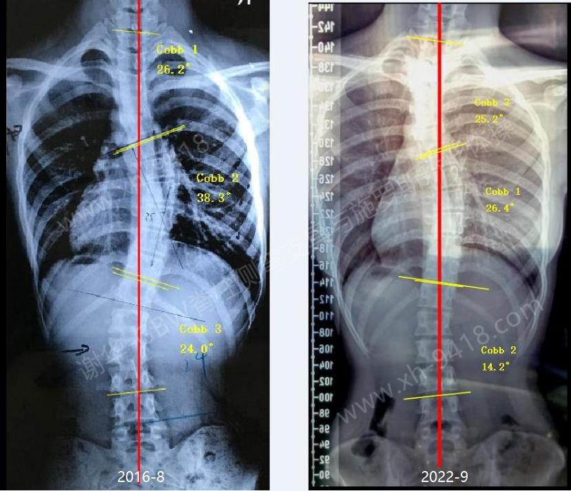 GBW支具成年后复查案例20220912    GBW脊柱侧弯支具矫正案例 第1张