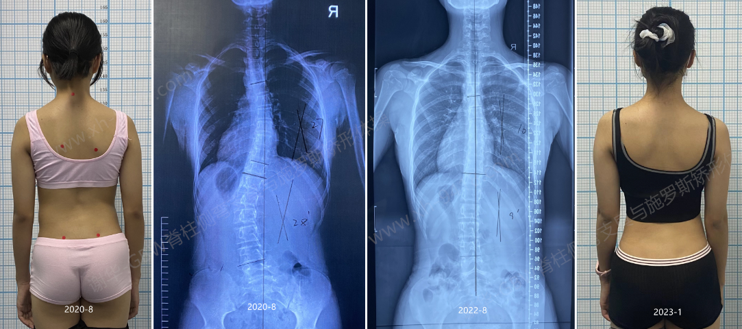 GBW施罗斯支具矫正案例20230204-两年的坚持 GBW脊柱侧弯支具矫正案例 第2张