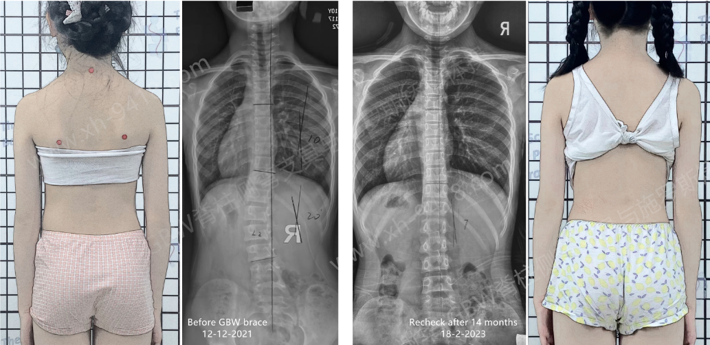 GBW支具案例20230218-生长期时侧弯容易矫正 GBW脊柱侧弯支具矫正案例 第1张