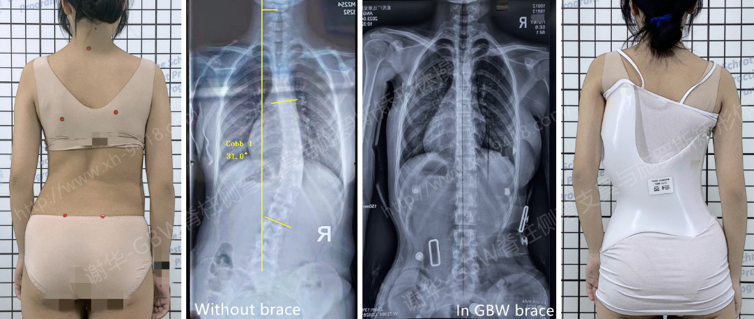 GBW支具案例20230412-大龄大度数好矫正吗 GBW脊柱侧弯支具矫正案例 第1张