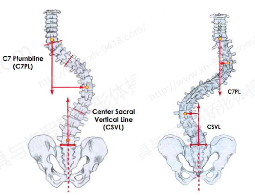 我的脊柱侧弯有几厘米？ 侧弯支具相关文章 第2张