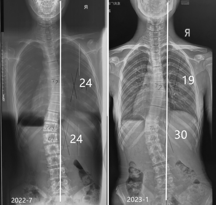 GBW支具案例20230530-传统支具更换GBW案例 GBW脊柱侧弯支具矫正案例 第1张