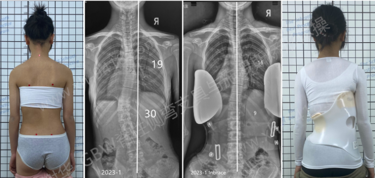 GBW支具案例20230530-传统支具更换GBW案例 GBW脊柱侧弯支具矫正案例 第2张