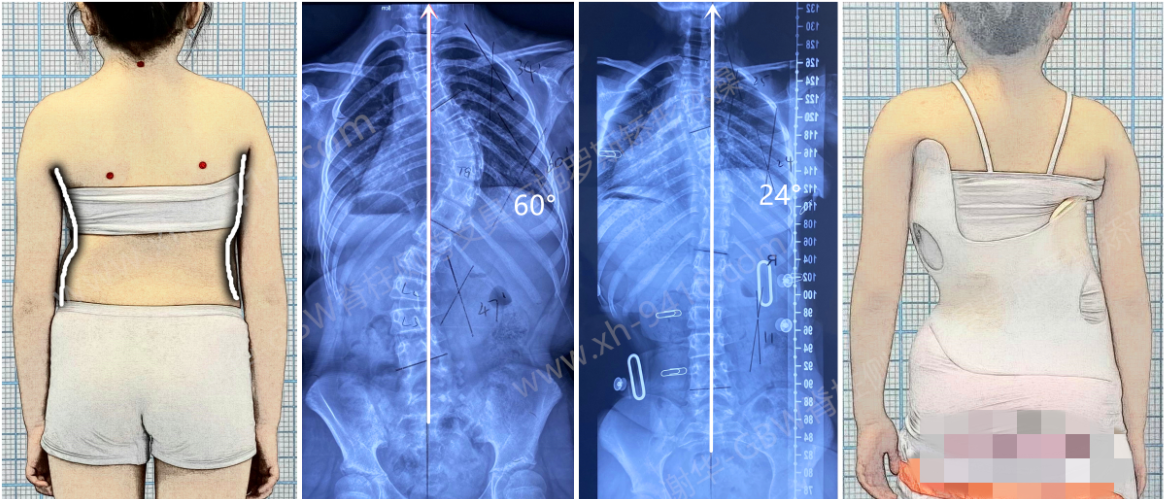 GBW施罗斯支具矫正案例——及早有效的矫正，60度也可改善 GBW脊柱侧弯支具矫正案例 第1张