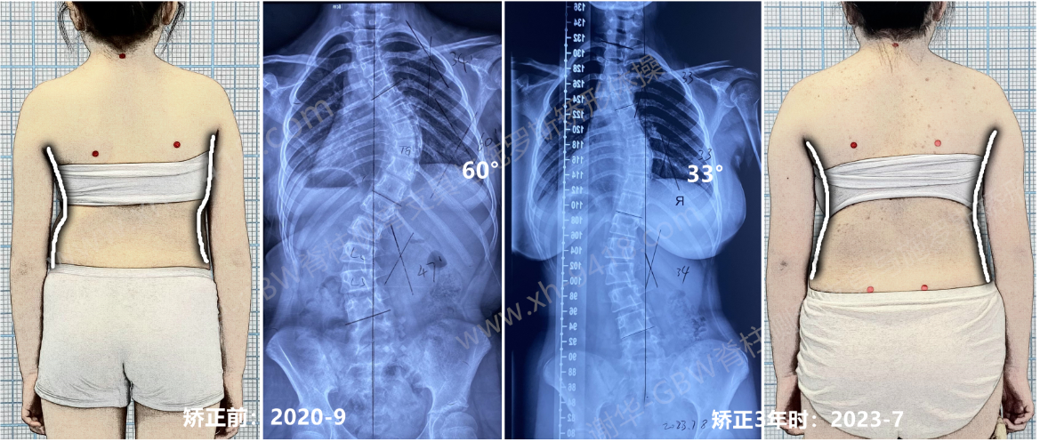 GBW施罗斯支具矫正案例——及早有效的矫正，60度也可改善 GBW脊柱侧弯支具矫正案例 第2张