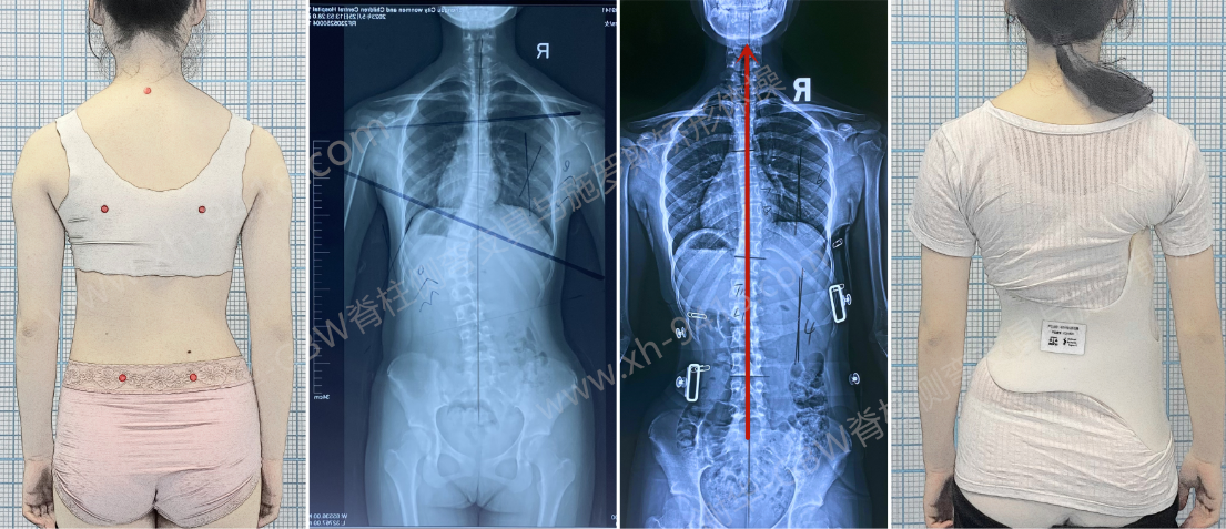 支具矫正案例-GBW支具小巧矫正率高 GBW脊柱侧弯支具矫正案例 第1张