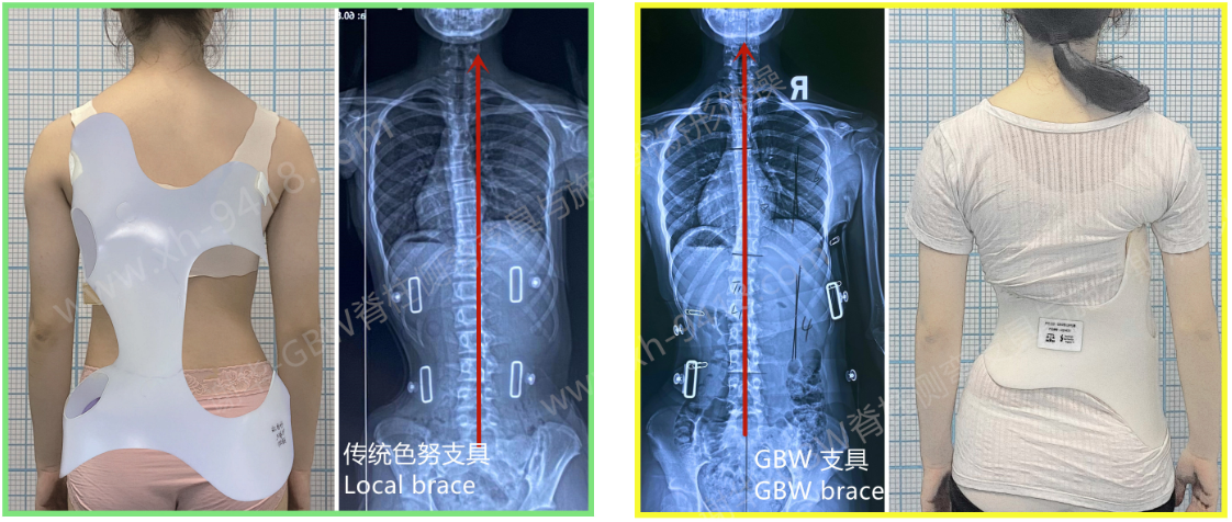 支具矫正案例-GBW支具小巧矫正率高 GBW脊柱侧弯支具矫正案例 第2张