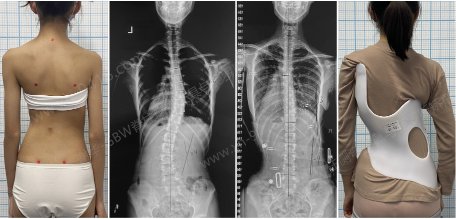 GBW支具案例20231021-持续矫正案例    GBW脊柱侧弯支具矫正案例 第1张