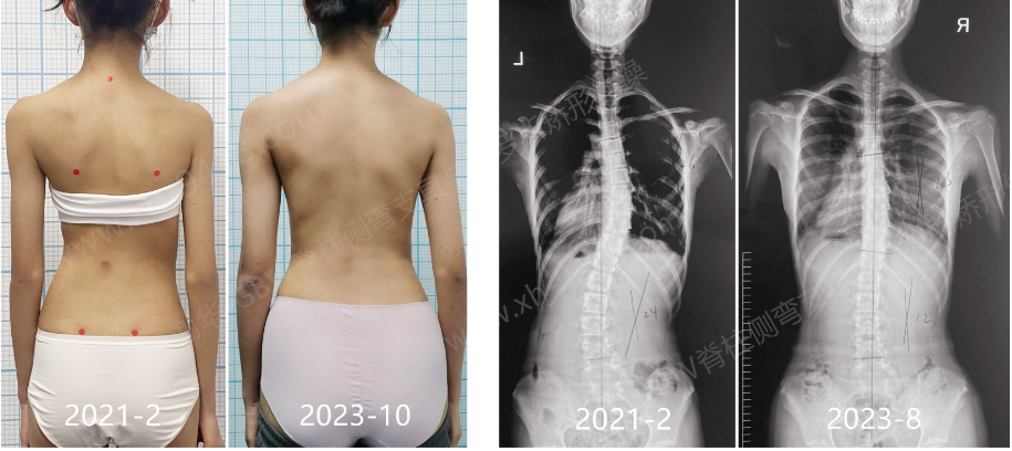 GBW支具案例20231021-持续矫正案例    GBW脊柱侧弯支具矫正案例 第2张