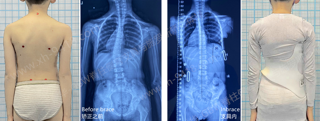 GBW支具案例-侧弯矫正恢复正常-20240128 GBW脊柱侧弯支具矫正案例 第1张