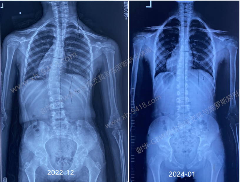 GBW支具案例-侧弯矫正恢复正常-20240128 GBW脊柱侧弯支具矫正案例 第2张