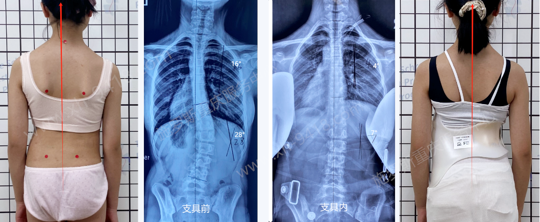 GBW支具案例20250119-生长期的短支具腰弯矫正 GBW脊柱侧弯支具矫正案例 第1张