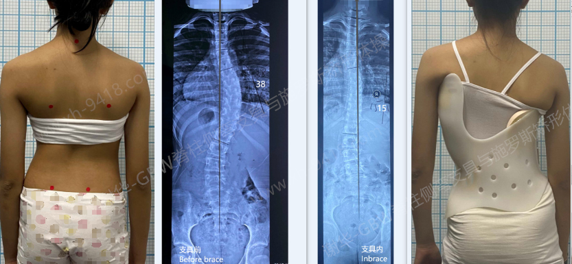 GBW支具案例-20250522 体形和度数同样重要 GBW脊柱侧弯支具矫正案例 第1张