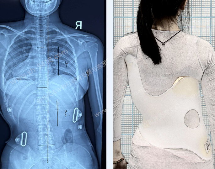 GBW支具案例20250918-两年坚持换来挺拔与自信 GBW脊柱侧弯支具矫正案例 第1张