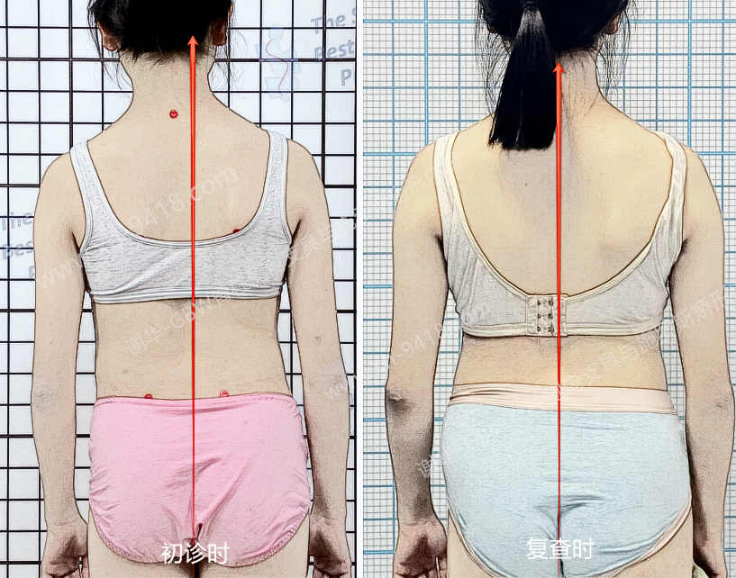 GBW支具案例20250918-两年坚持换来挺拔与自信 GBW脊柱侧弯支具矫正案例 第2张