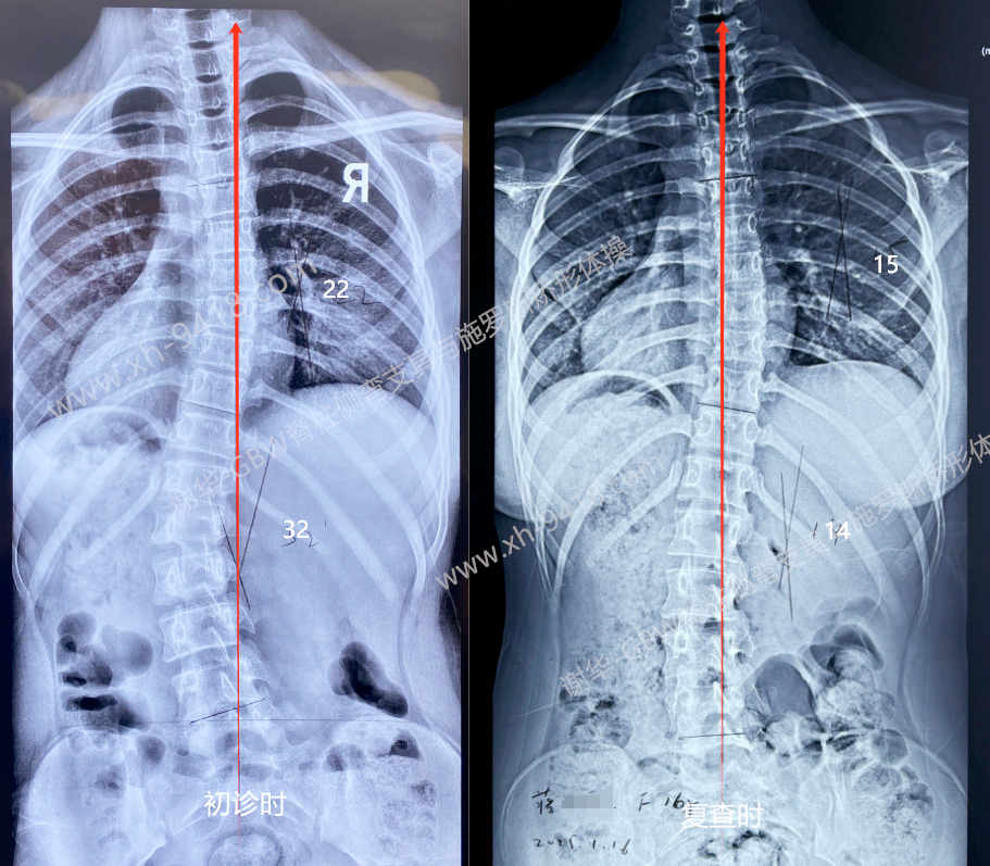 GBW支具案例20250918-两年坚持换来挺拔与自信 GBW脊柱侧弯支具矫正案例 第3张