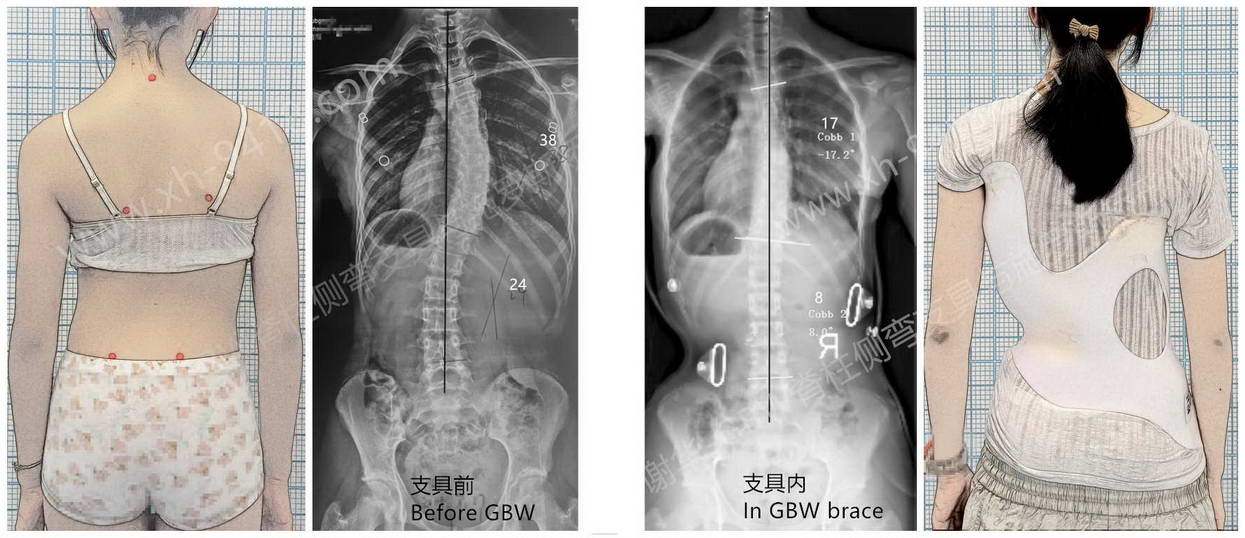 支具情况-mark.jpg GBW支具案例20251205-胸主弯的“S”形曲线矫正进展 GBW脊柱侧弯支具矫正案例 第1张 GBW支具案例20251205-胸主弯的“S”形曲线矫正进展 GBW脊柱侧弯支具矫正案例 第1张