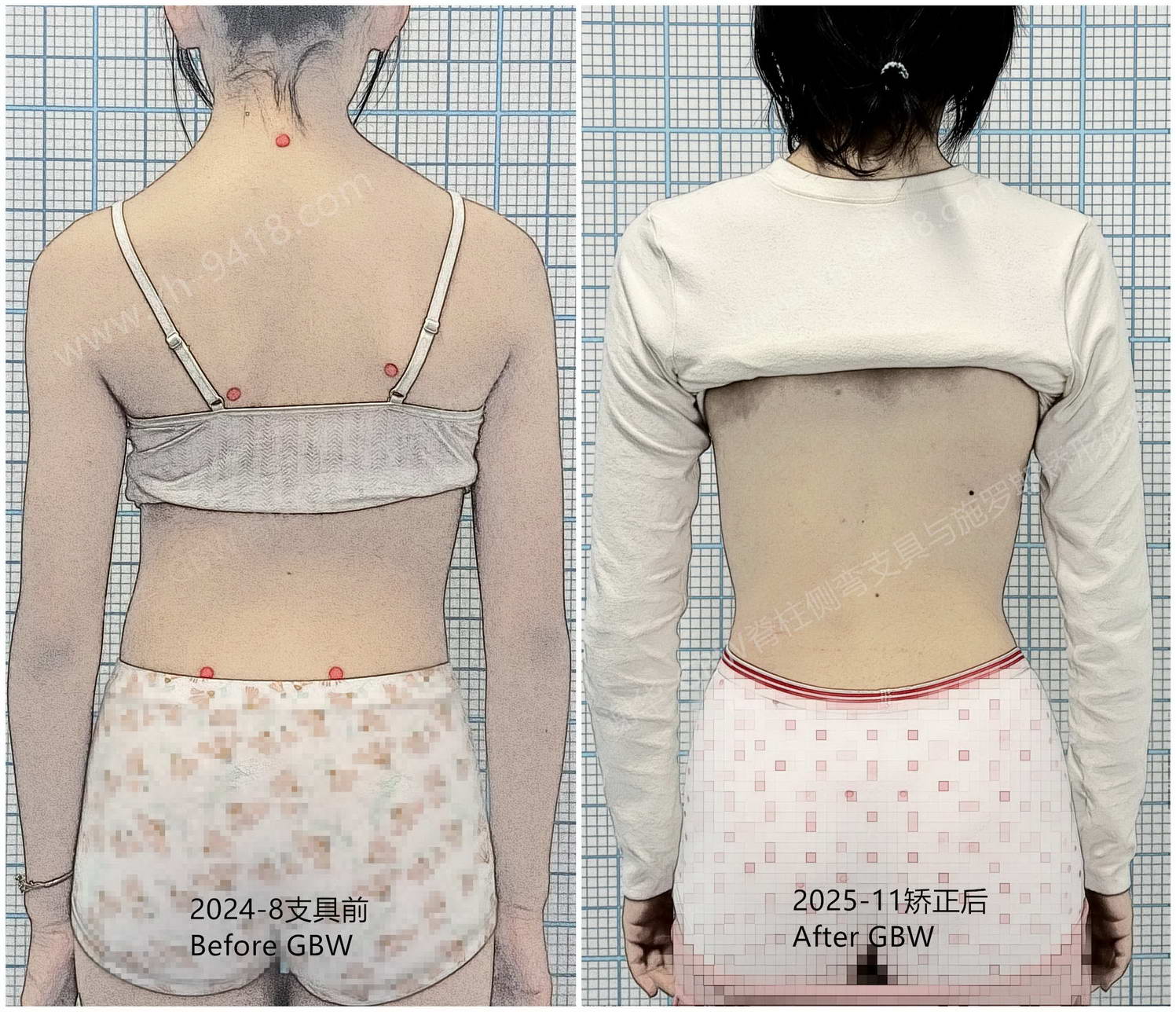 复查对比-S-mark.jpg GBW支具案例20251205-胸主弯的“S”形曲线矫正进展 GBW脊柱侧弯支具矫正案例 第2张 GBW支具案例20251205-胸主弯的“S”形曲线矫正进展 GBW脊柱侧弯支具矫正案例 第2张