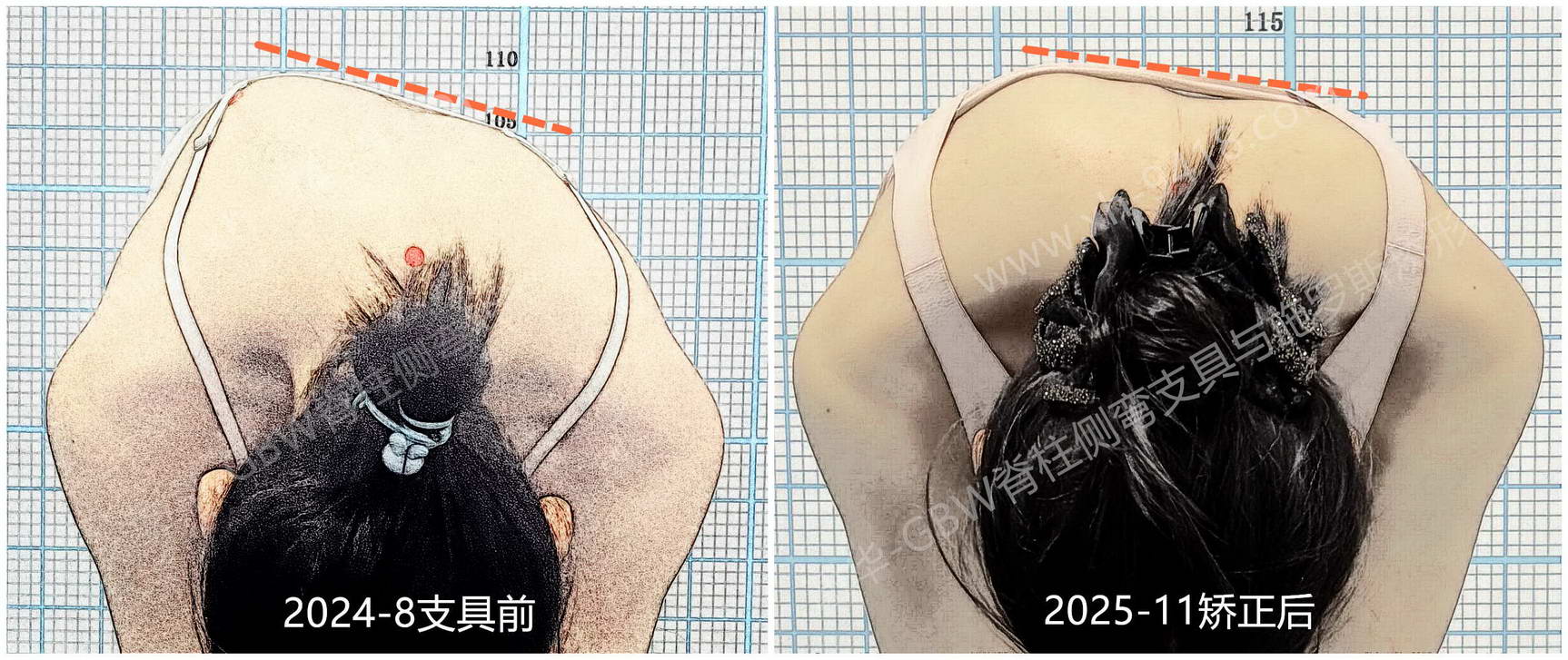 复查对比-B-mark.jpg GBW支具案例20251205-胸主弯的“S”形曲线矫正进展 GBW脊柱侧弯支具矫正案例 第3张 GBW支具案例20251205-胸主弯的“S”形曲线矫正进展 GBW脊柱侧弯支具矫正案例 第3张