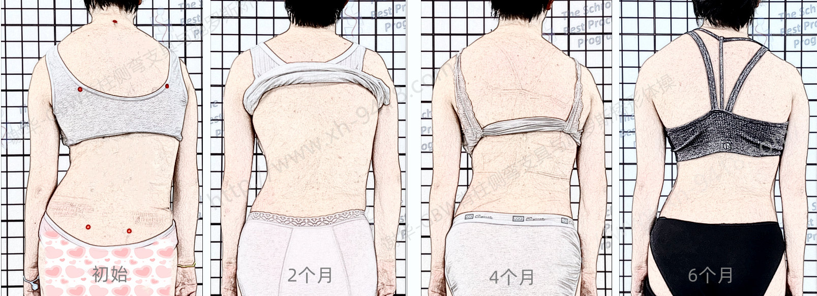 GBW支具案例20260104-严重侧弯的案例 GBW脊柱侧弯支具矫正案例 第1张