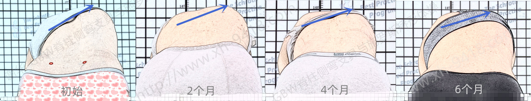 GBW支具案例20260104-严重侧弯的案例 GBW脊柱侧弯支具矫正案例 第2张