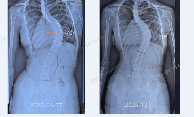GBW支具案例20260104-严重侧弯的案例 GBW脊柱侧弯支具矫正案例 第3张