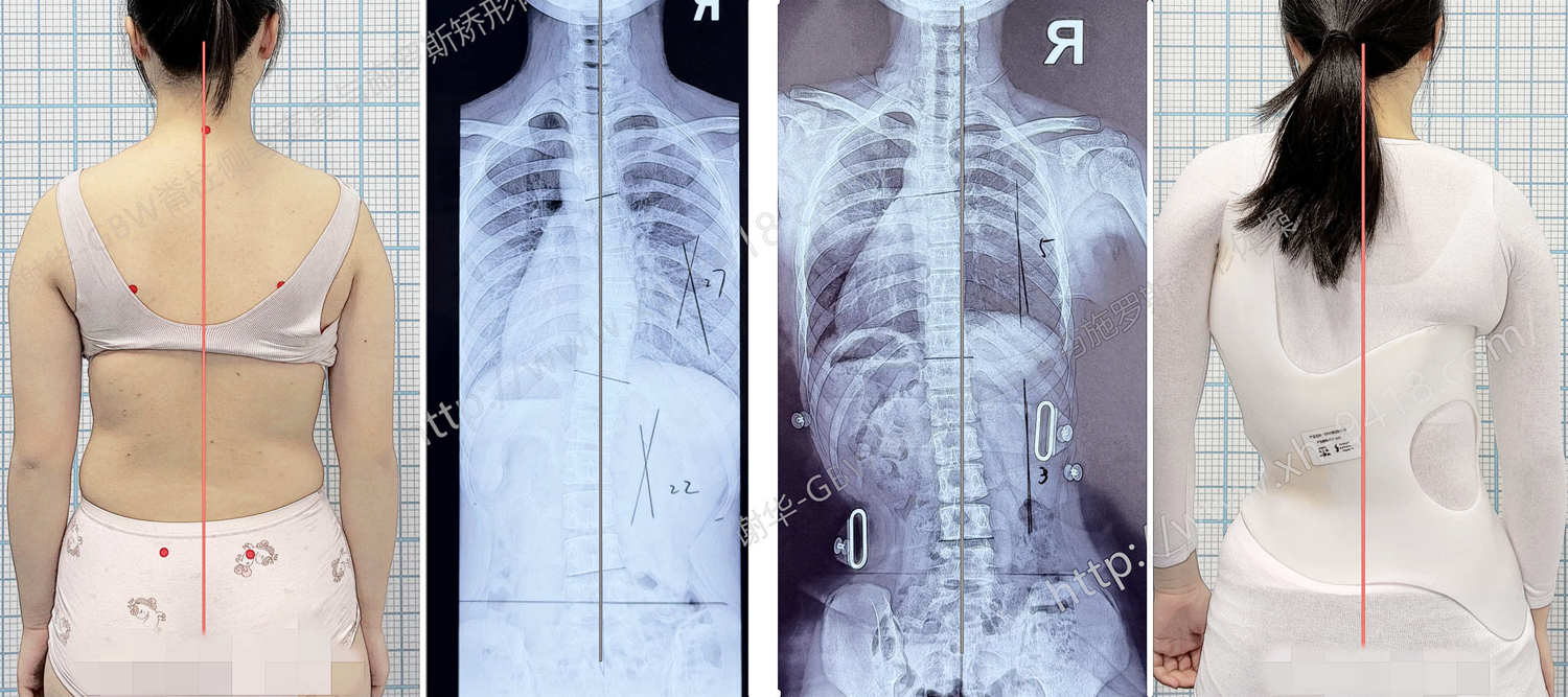GBW支具案例20260315-进展中的侧弯要及时矫正 GBW脊柱侧弯支具矫正案例 第1张