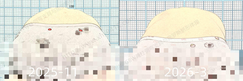 GBW支具案例20260315-进展中的侧弯要及时矫正 GBW脊柱侧弯支具矫正案例 第3张